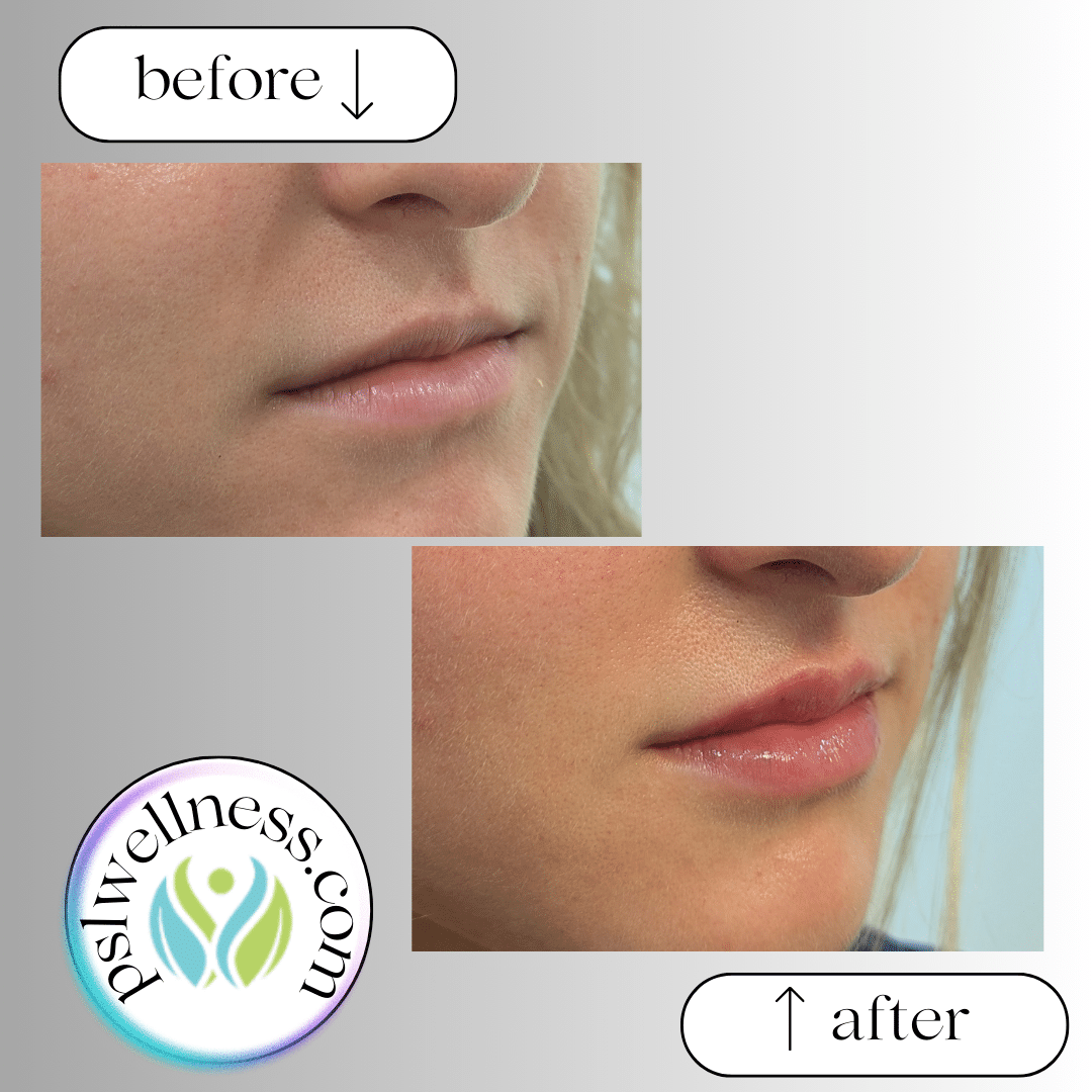 Before and After Image: Lip Filler - right-front-oblique