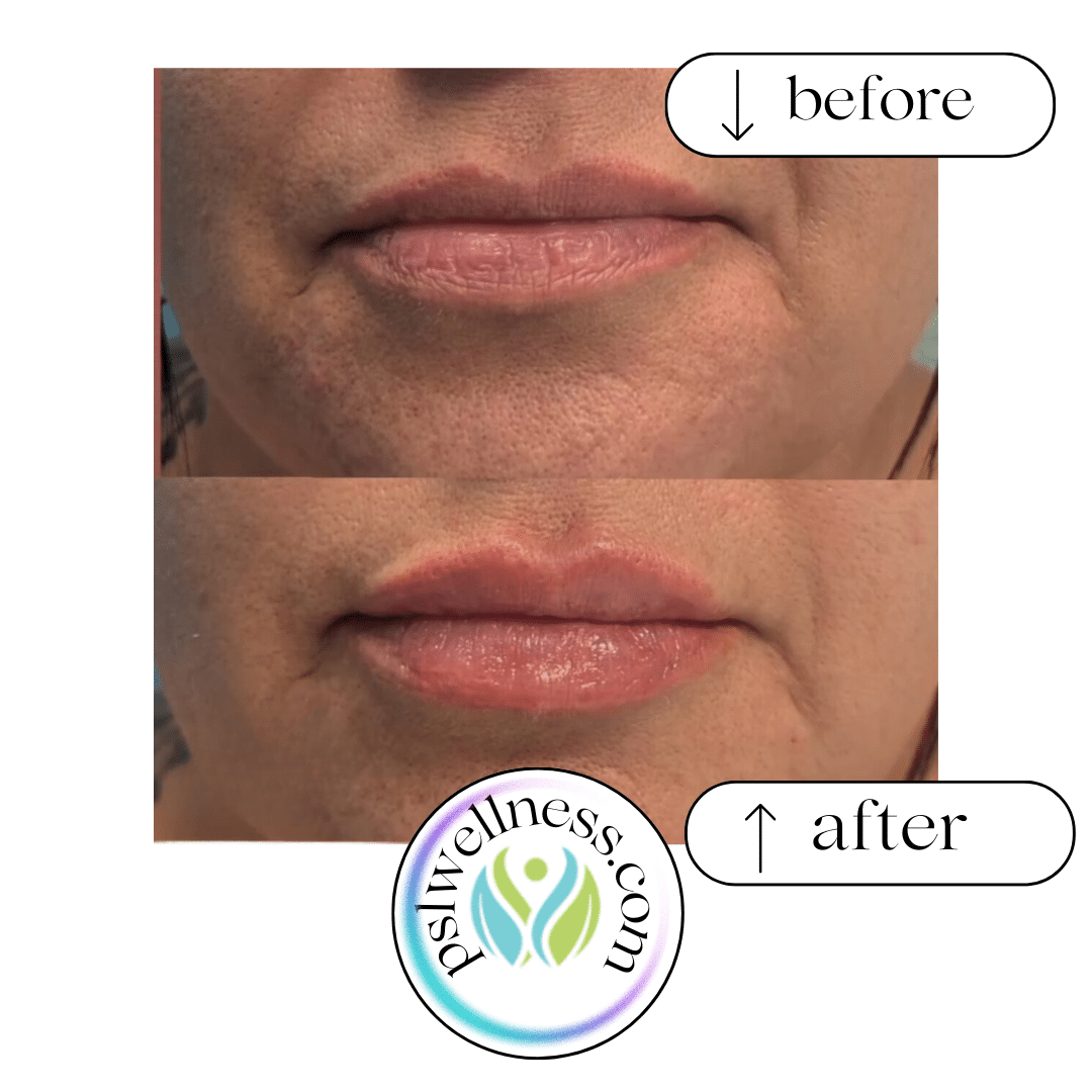 Before and After Image: Lip Filler - front