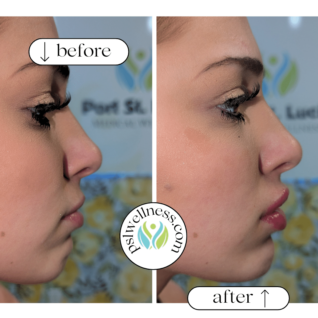 Before and After Image: Facial Balancing with Chin & Lip Filler - right-side